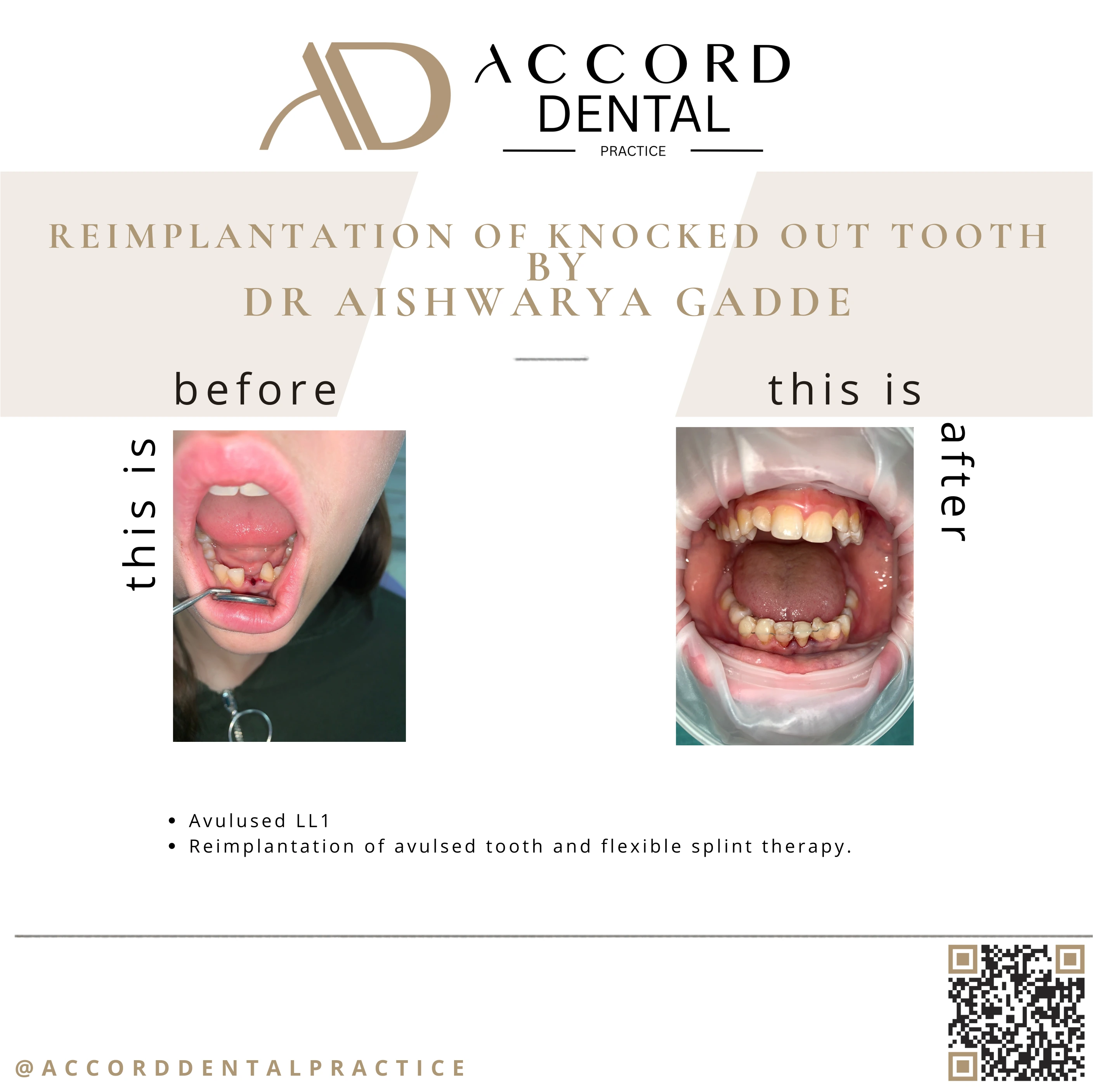 Reimplantation of knocked out tooth avulsed LL1 with flexible splint - before and after, Accord Dental Practice Camberley