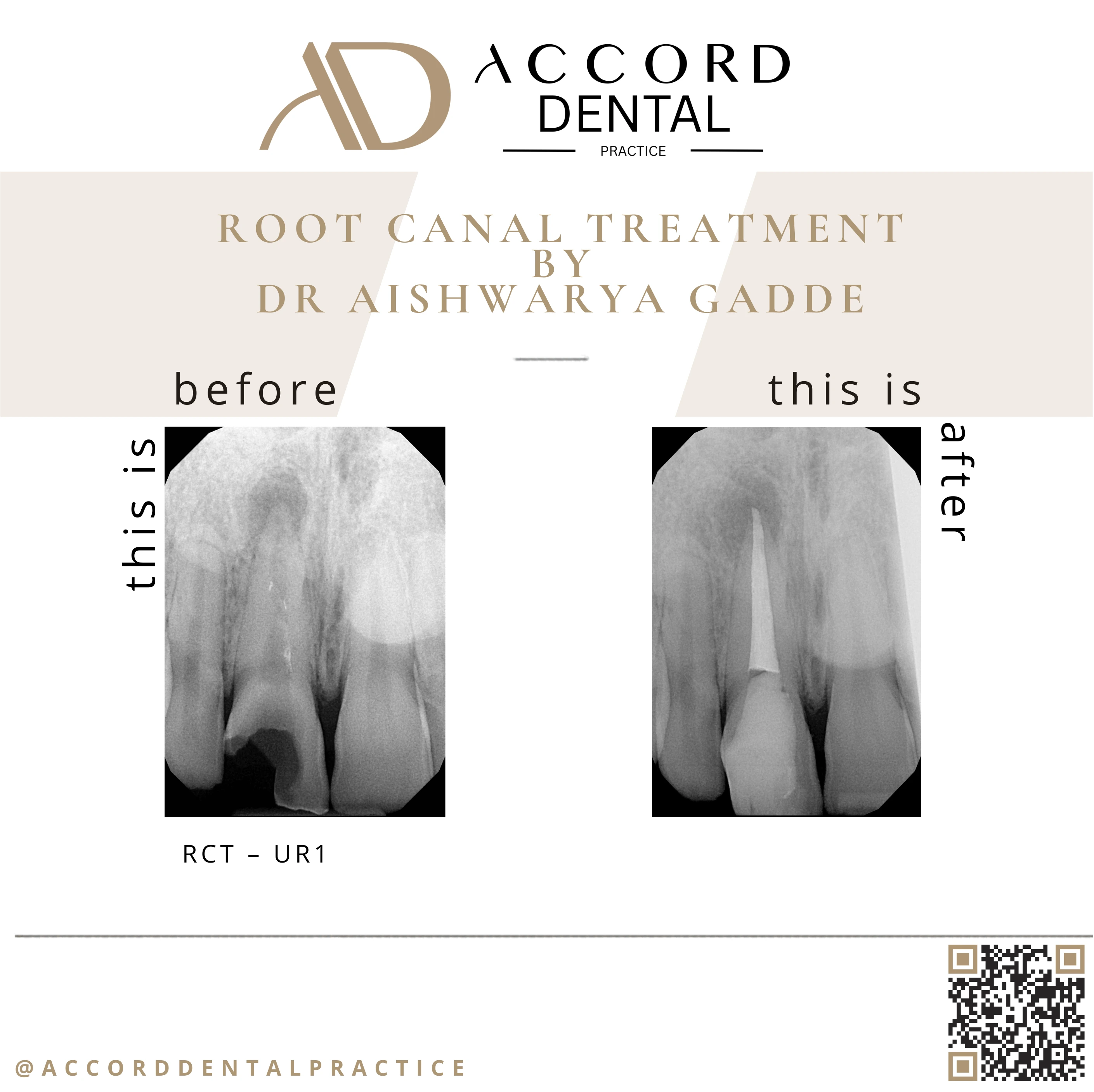 Root canal treatment RCT UR1 - before and after X-ray, Accord Dental Practice Camberley