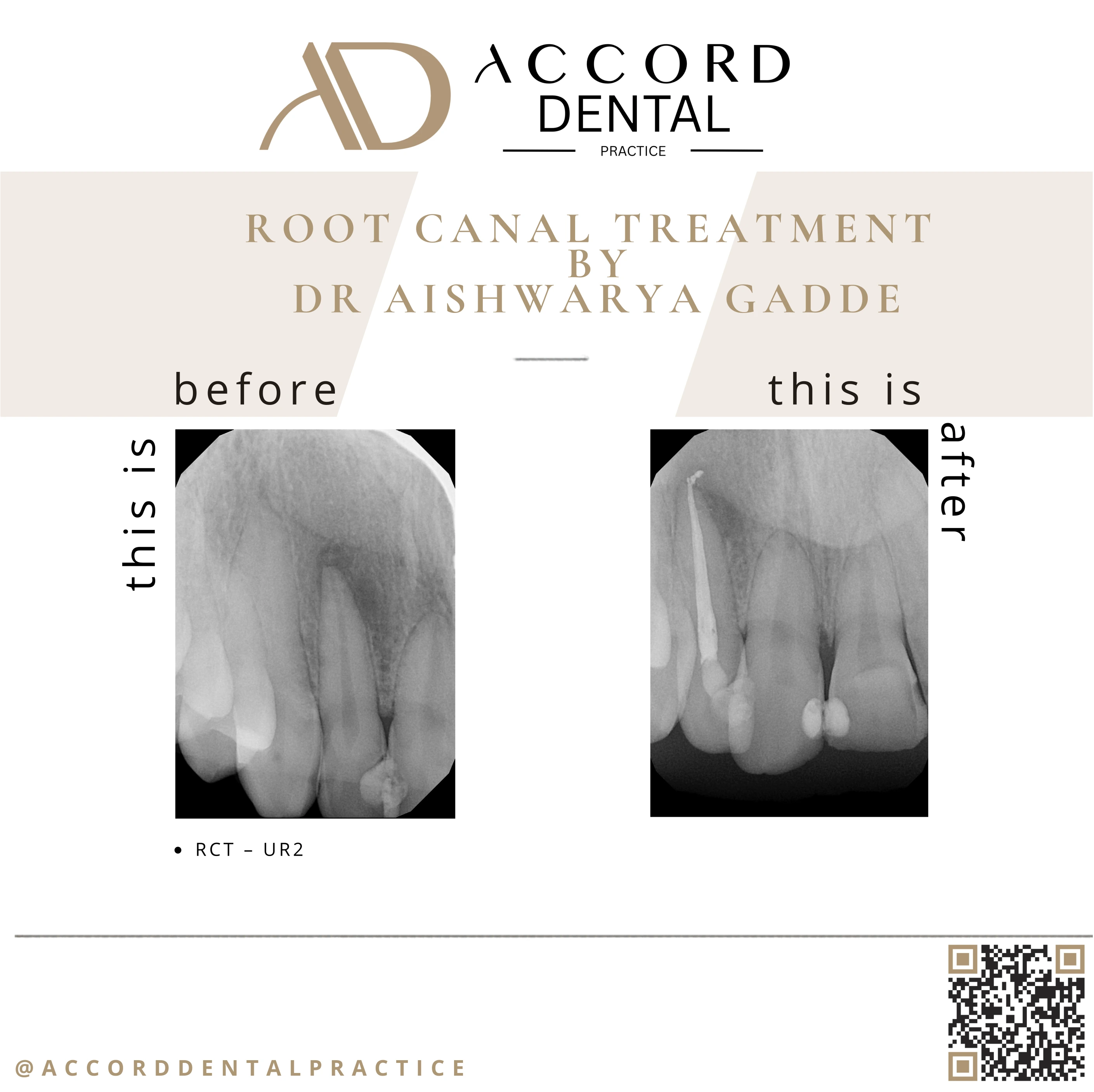 Root canal treatment RCT LR1 - before and after X-ray, Accord Dental Practice Camberley