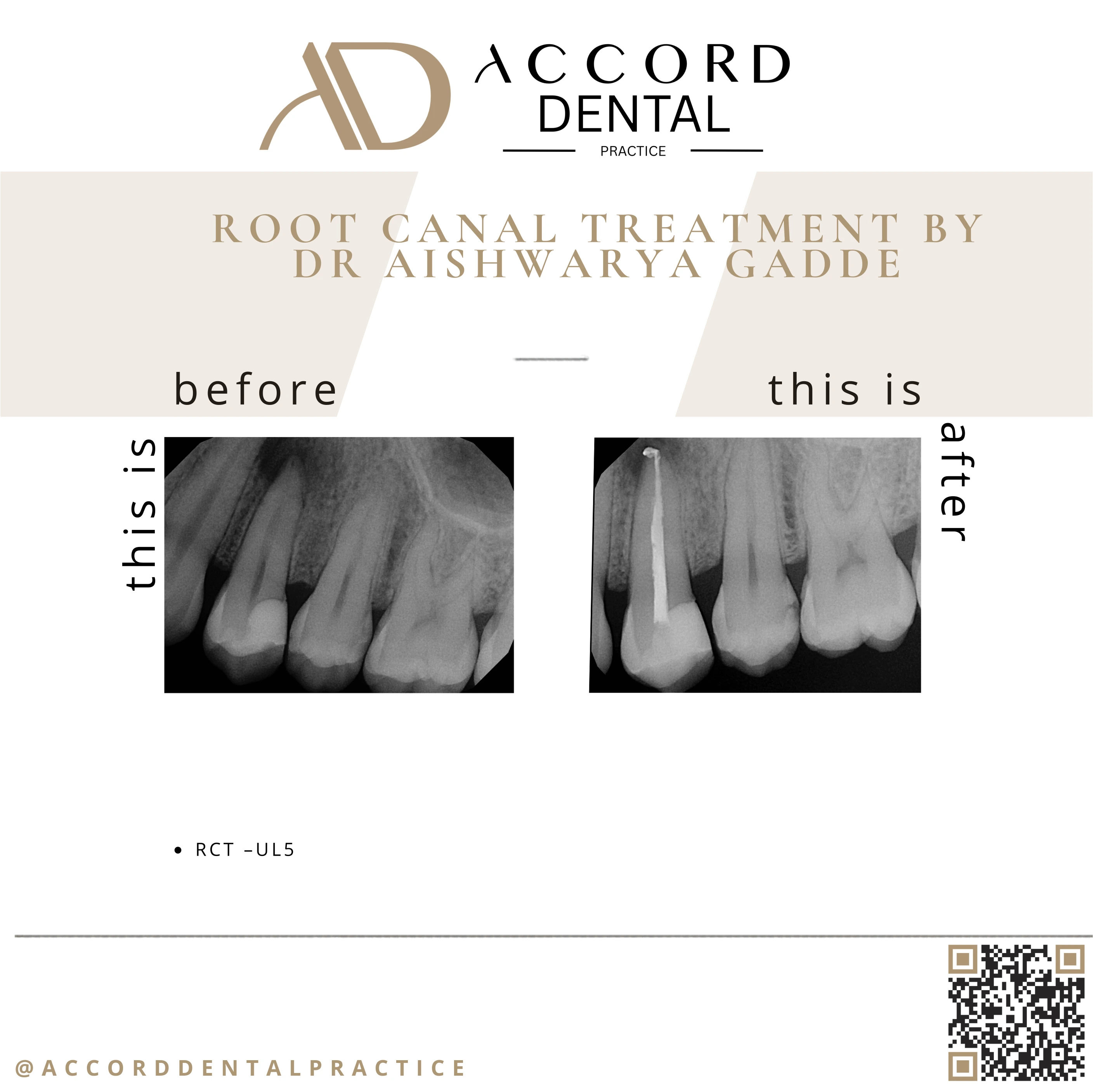 Root canal treatment RCT UL5 - before and after X-ray, Accord Dental Practice Camberley