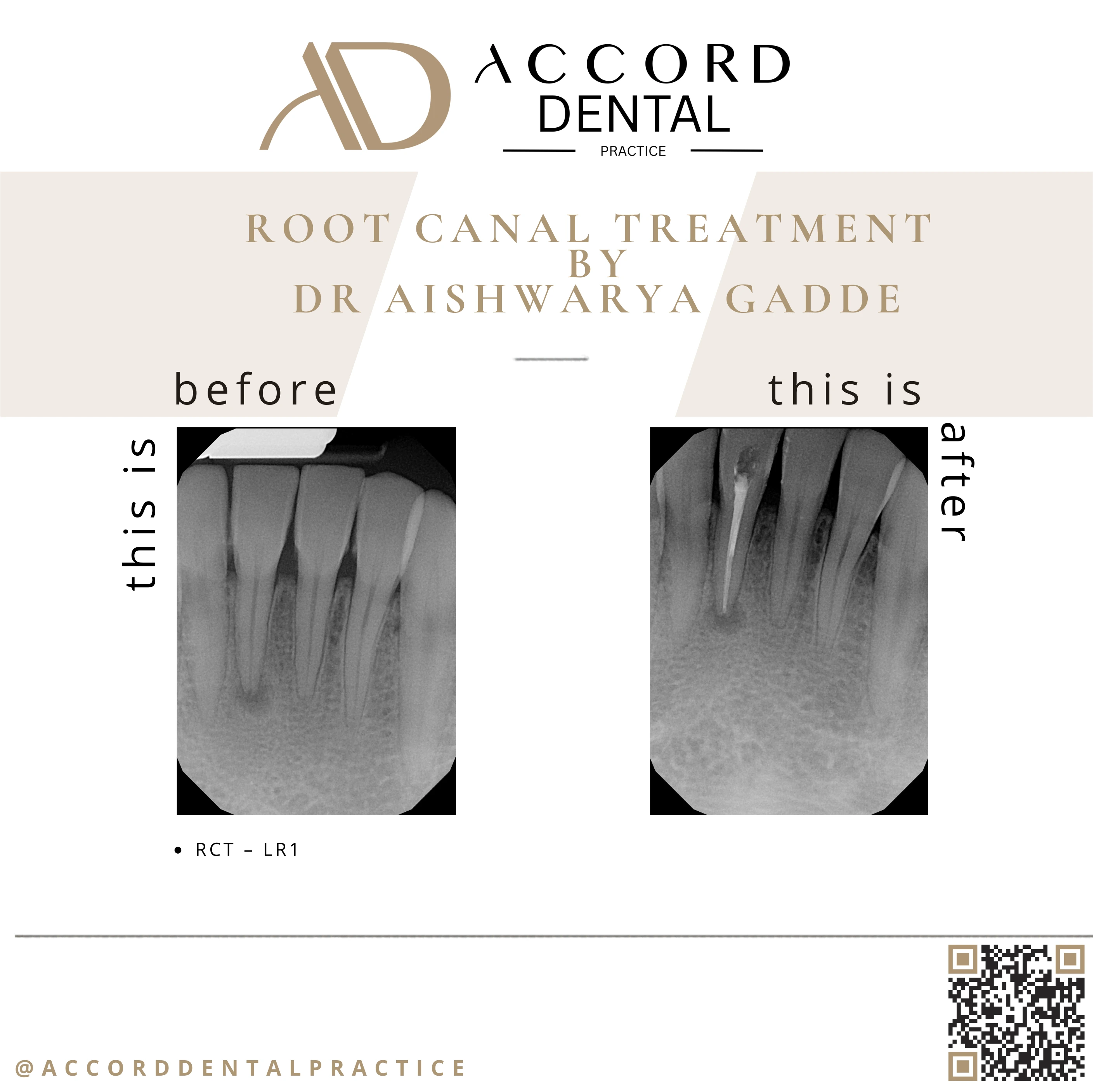 Root canal treatment RCT UL6 - before and after X-ray, Accord Dental Practice Camberley