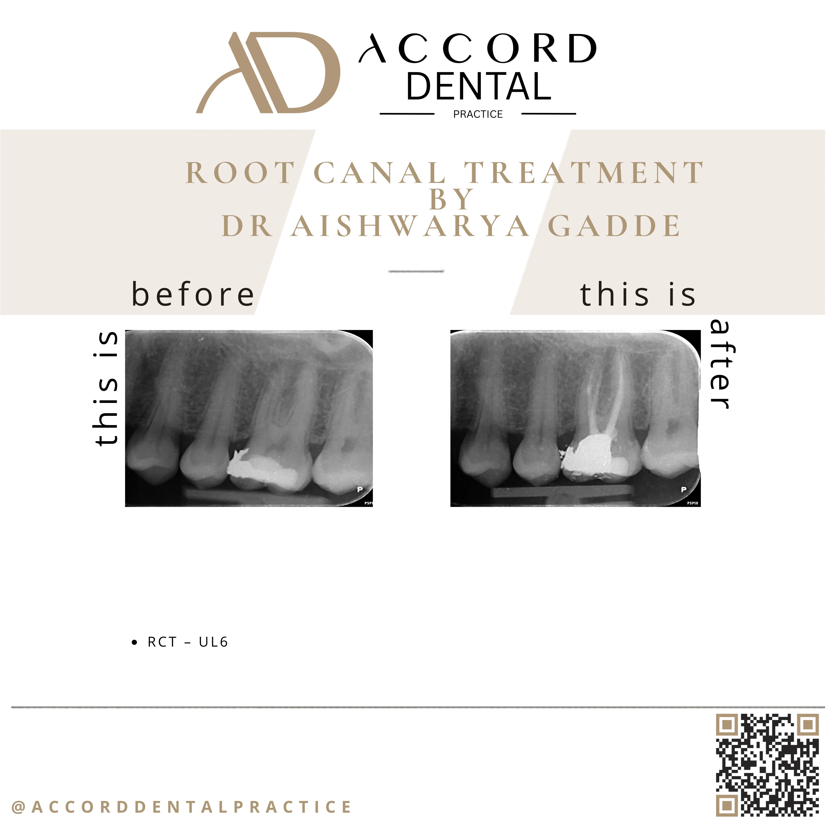 Root canal treatment RCT UR2 - before and after X-ray, Accord Dental Practice Camberley