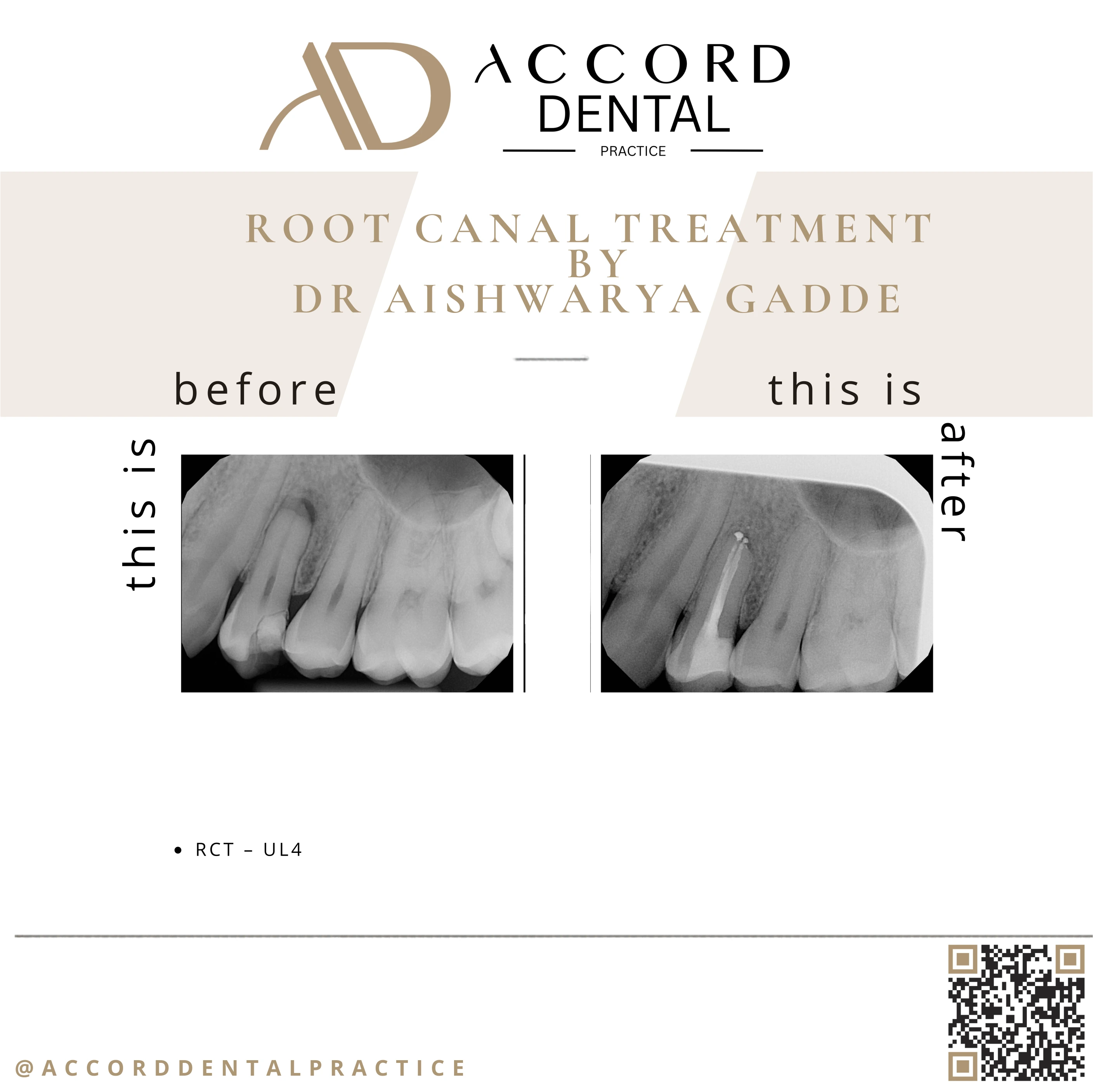 Root canal treatment RCT UL4 - before and after X-ray, Accord Dental Practice Camberley