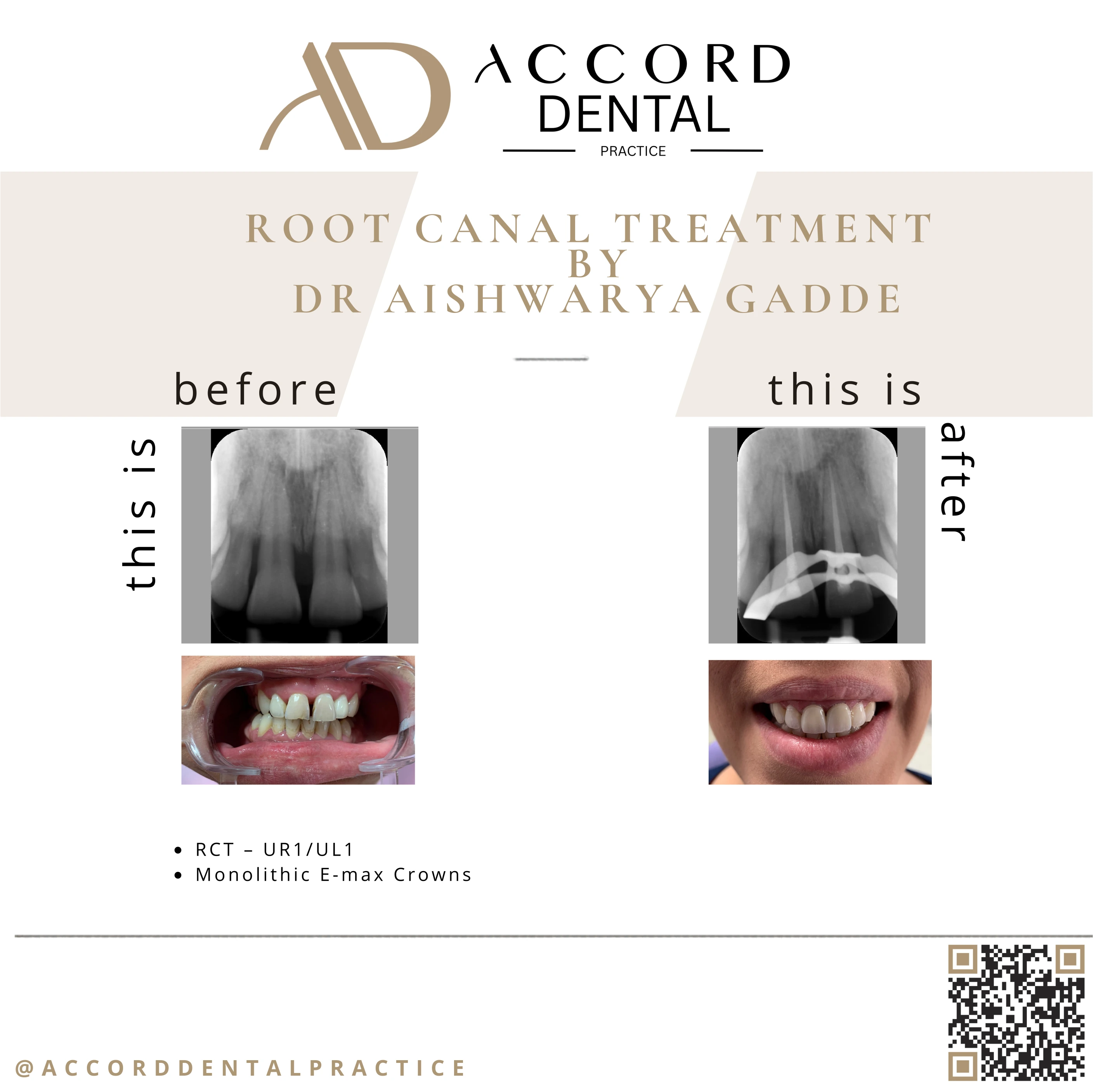 Root canal treatment with E-max crowns RCT UR1 UL1 - before and after, Accord Dental Practice Camberley