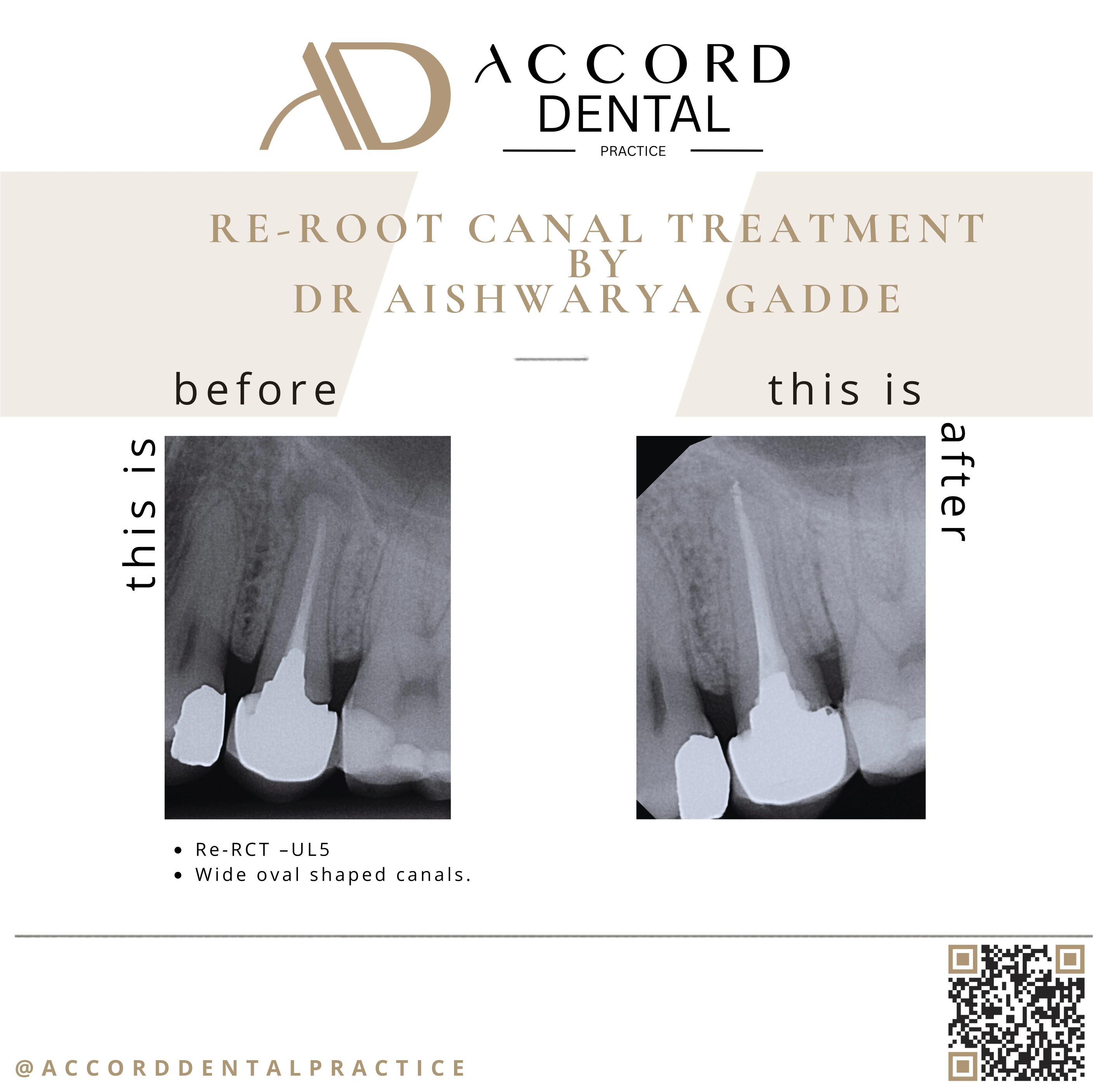 Re-root canal treatment Re-RCT UL5 wide oval canals - before and after, Accord Dental Practice Camberley