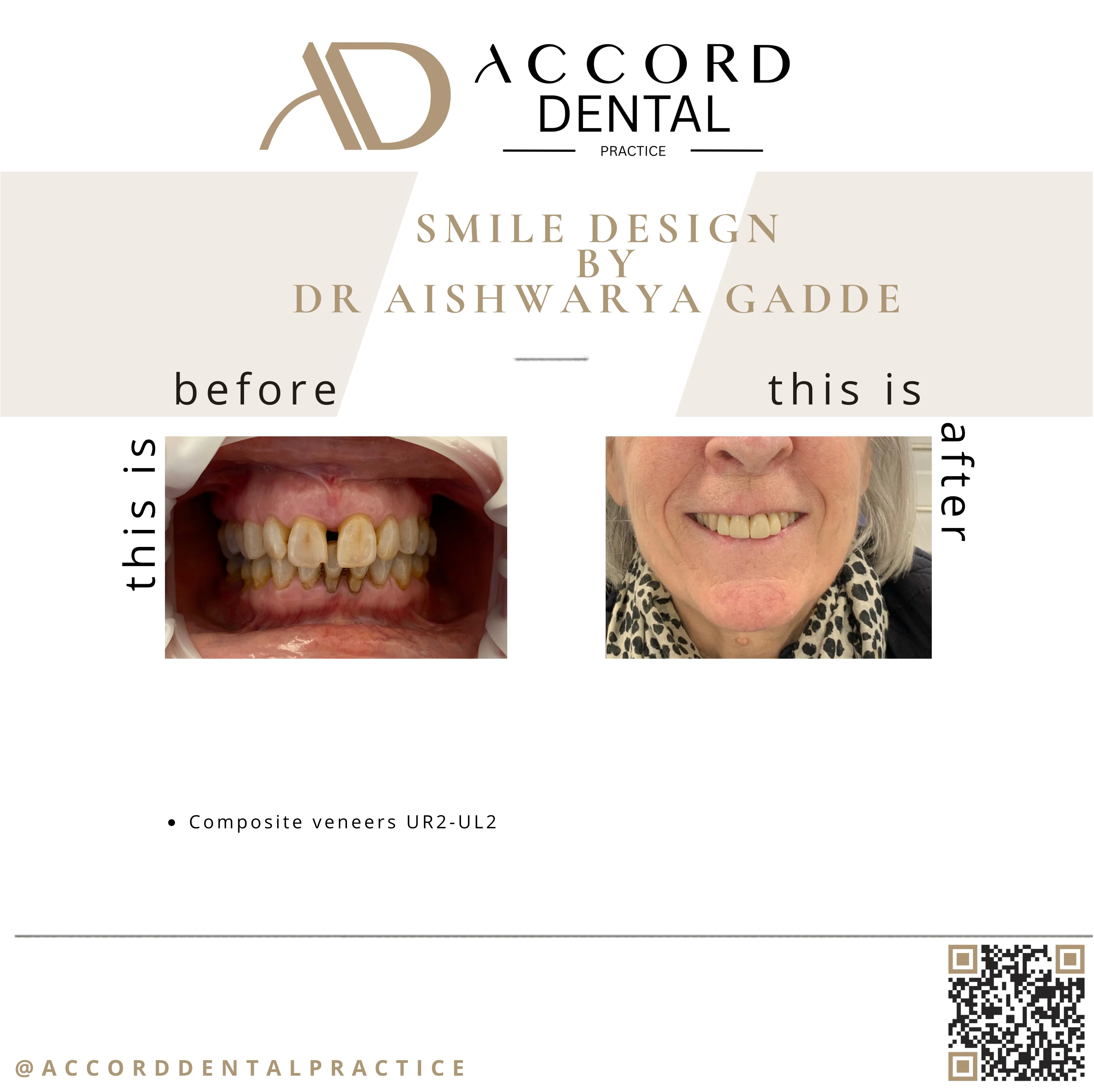 Smile design composite veneers UR2 to UL2 - before and after, Accord Dental Practice Camberley