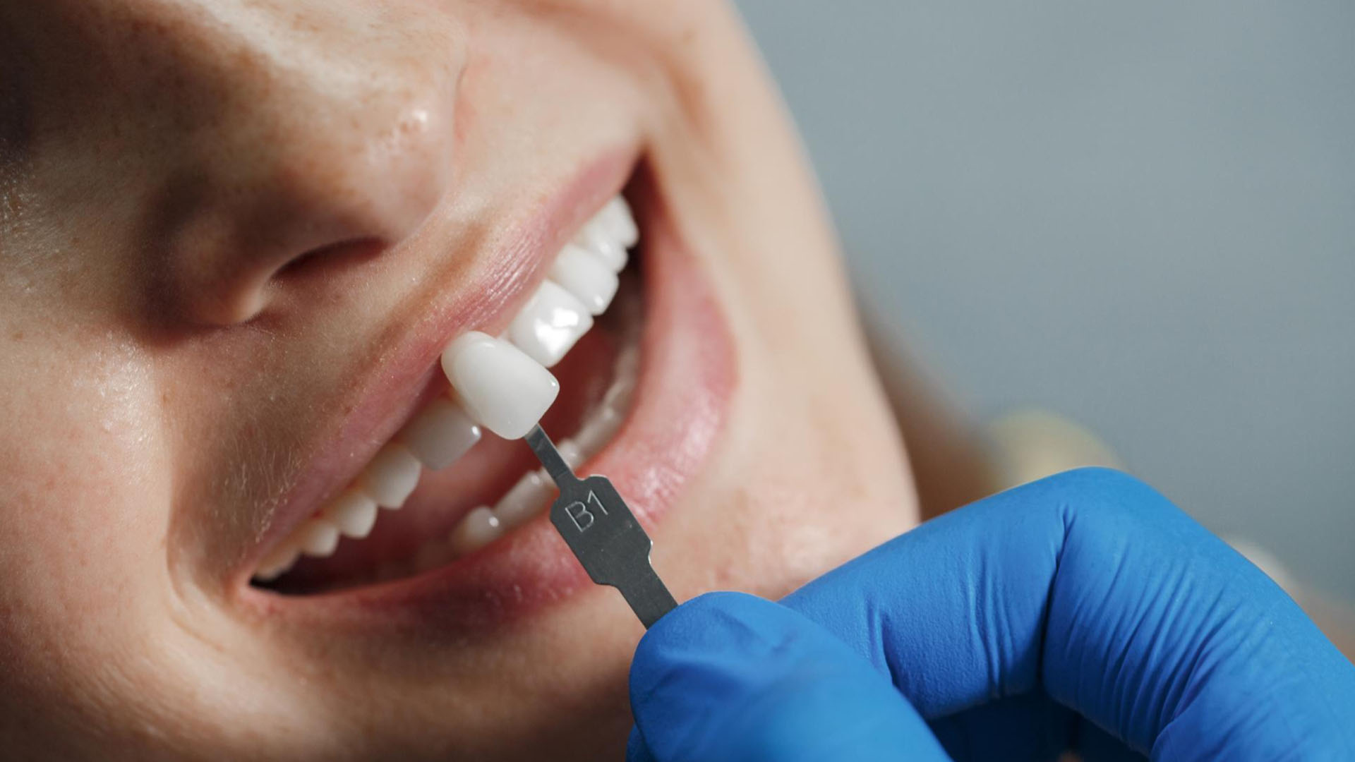 Dental bridges treatment banner at Accord Dental Practice