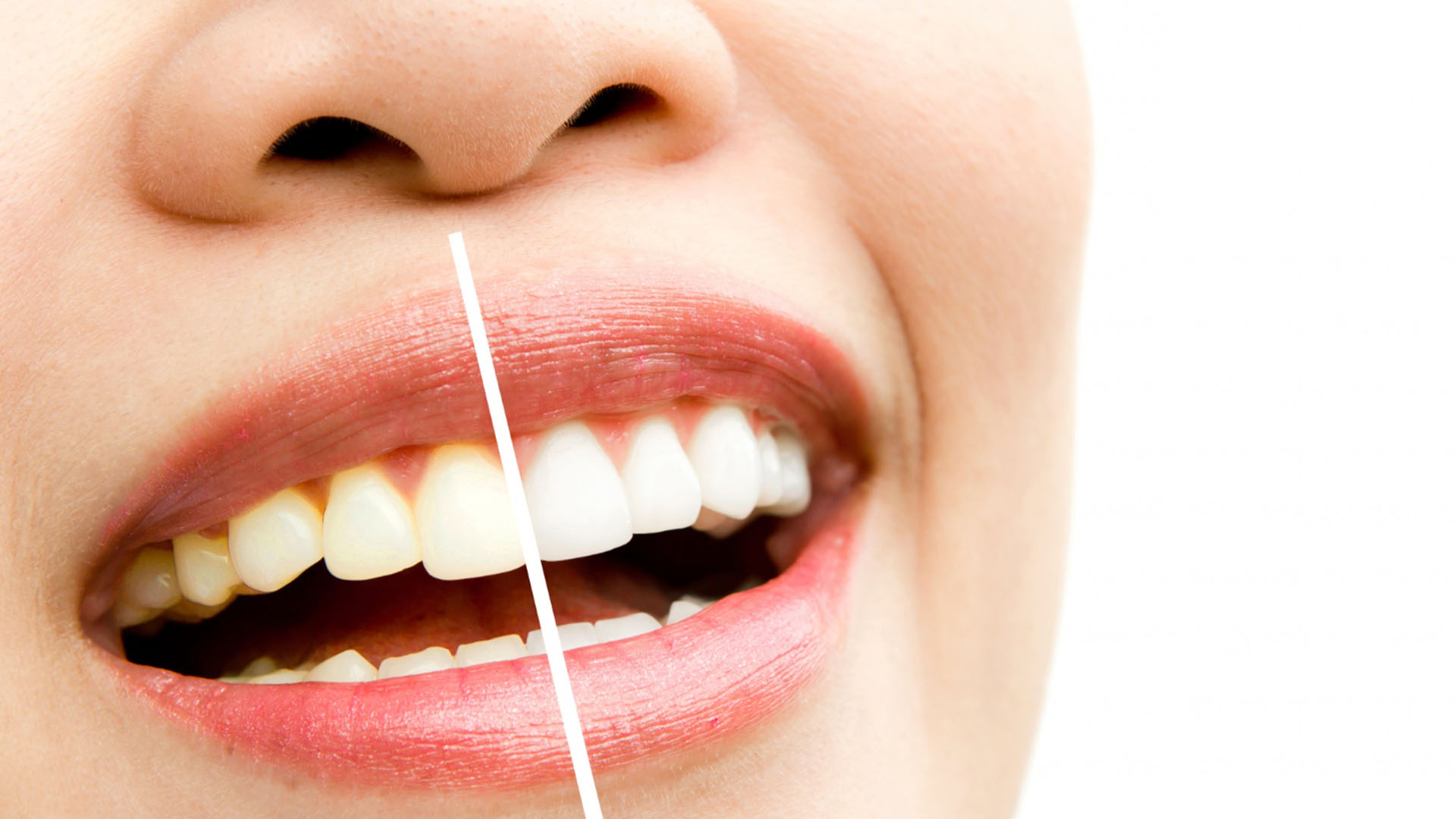 Teeth whitening banner at Accord Dental Practice
