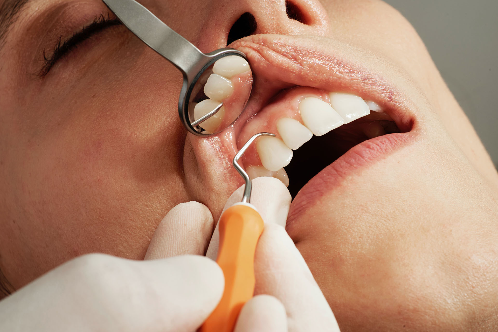Dental Filling dental treatment banner at Accord Dental Practice